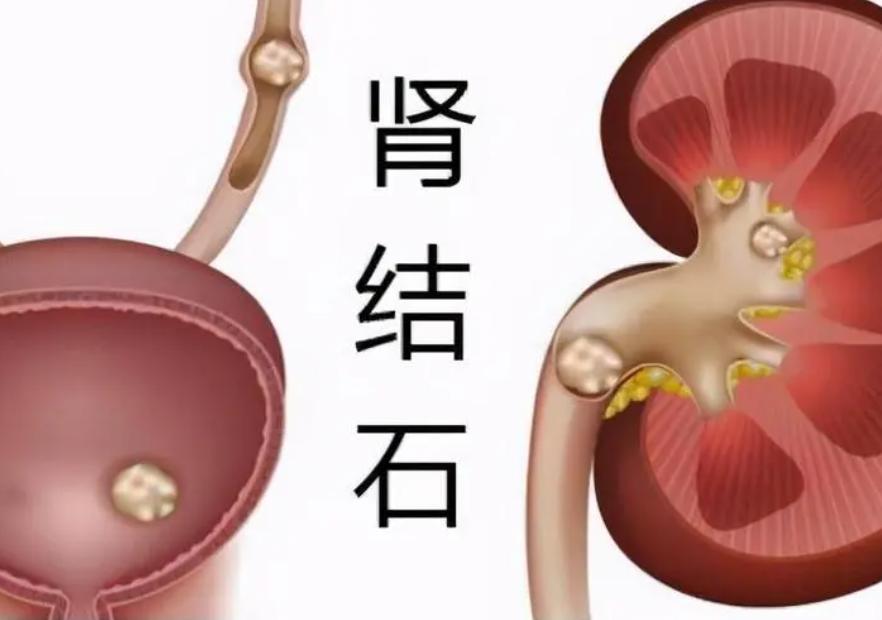 儿童有肾结石,儿童多发性肾结石