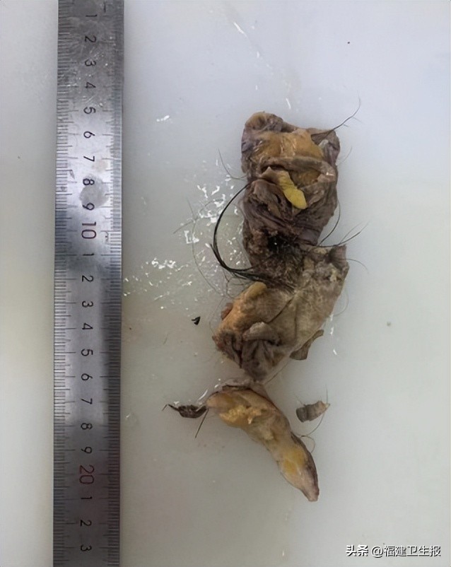 少女卵巢里长满毛发、牙槽骨!省妇幼保健院孙蓬明教授团队仅用2厘米切口巧取足球大小“怪胎”