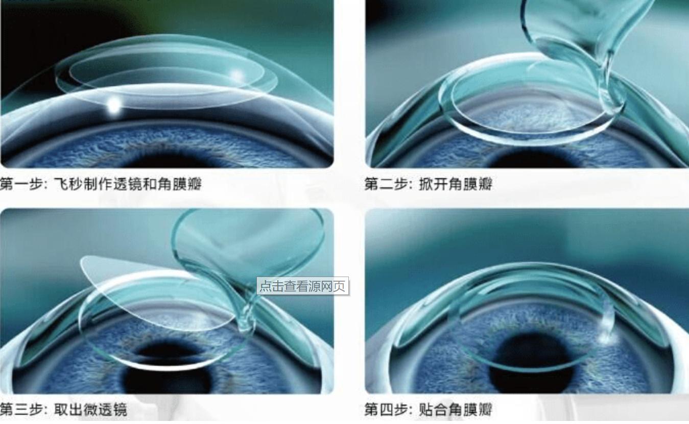 全飞秒近视手术成功率有多高,全飞秒是完全治疗近视吗