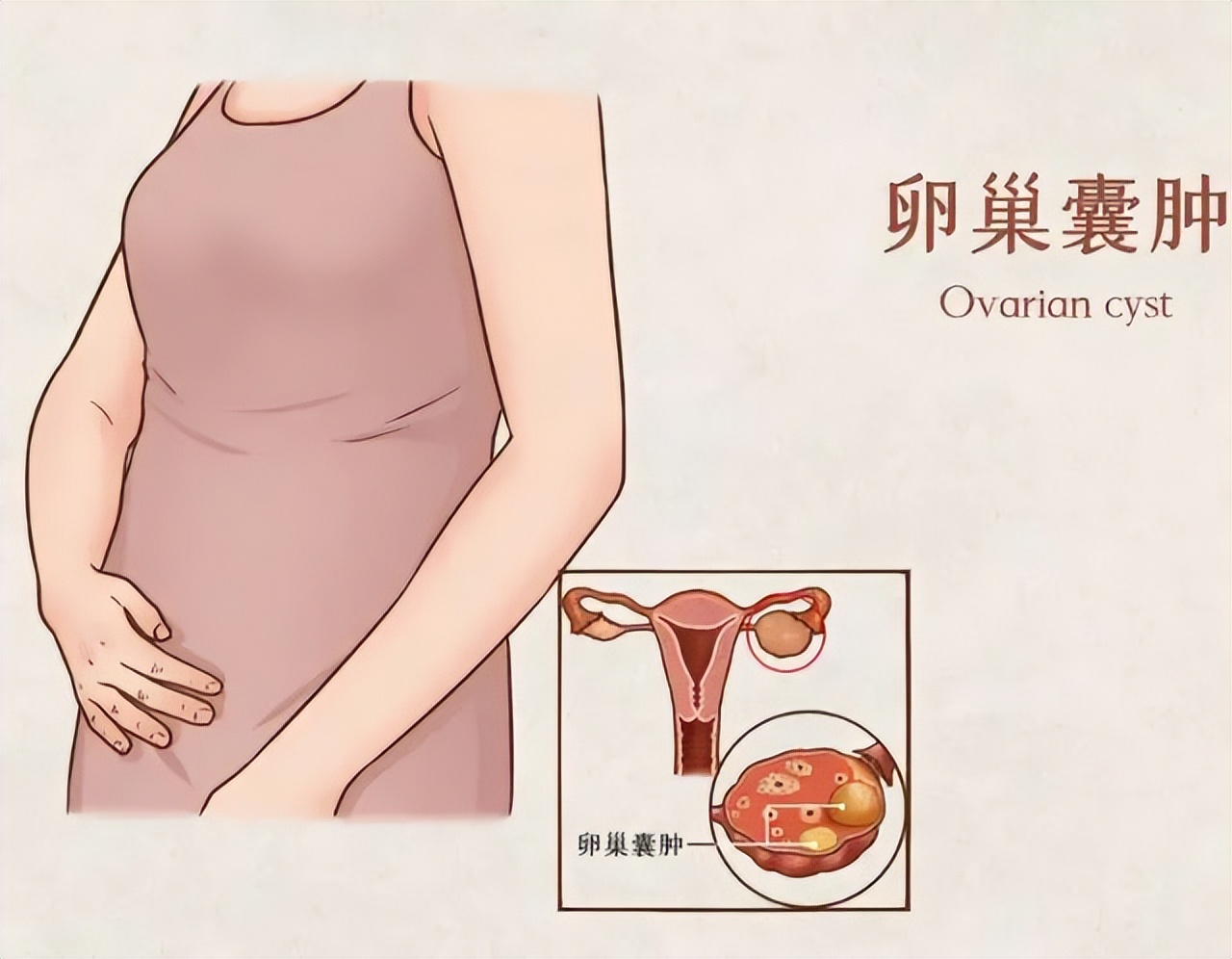 卵巢囊肿会不会死亡,卵巢囊肿需要陪护吗