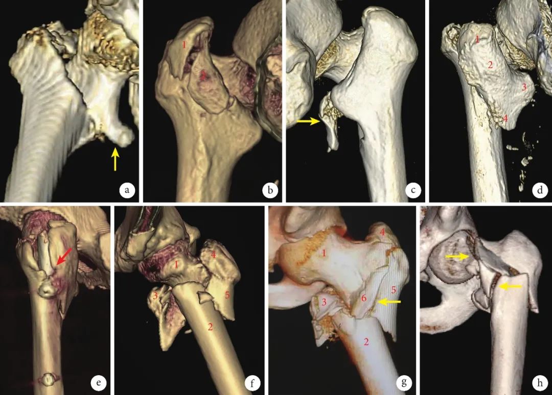 股骨转子间骨折四种手术方法比较,股骨转子间骨折属于轻伤还是重伤