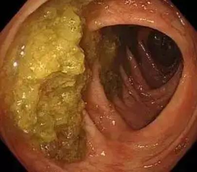 肠道准备不满意影响视野,肠道准备不充分肠镜会漏诊吗