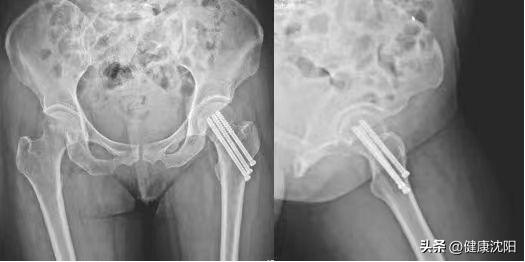 老年人怎么会引起股骨颈骨折,高龄老人股骨颈骨折怎么办恢复快