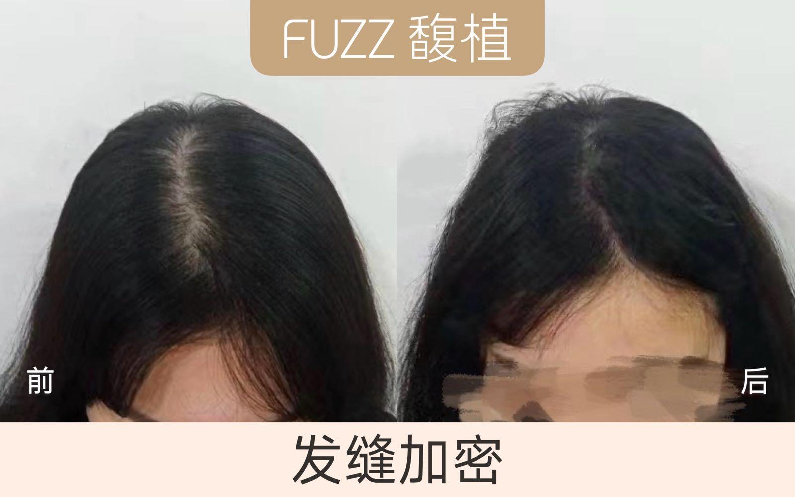 熬夜为什么脱发,熬夜脱发怎么办男生