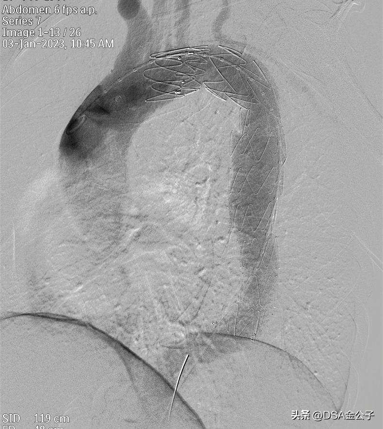 主动脉夹层动脉瘤哪个医院好,主动脉夹层动脉瘤遗传率多高