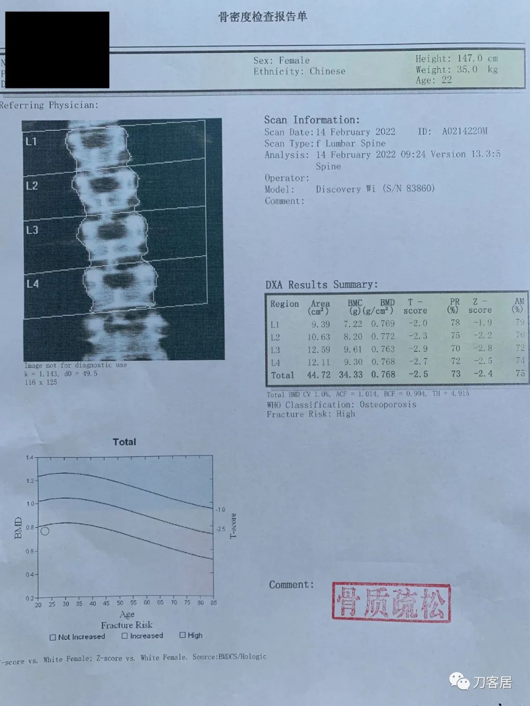 我的门诊病历：22岁女性，骨质疏松症，骶管囊肿
