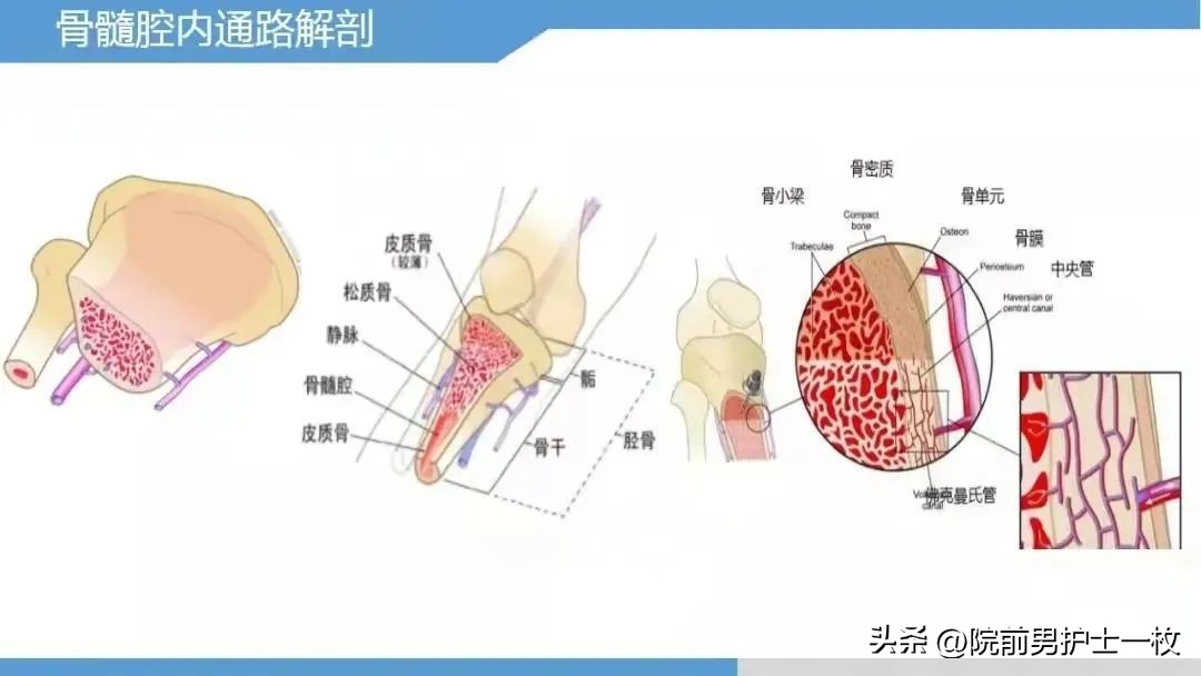 骨髓腔穿刺自动技术操作流程,骨髓腔穿刺急救