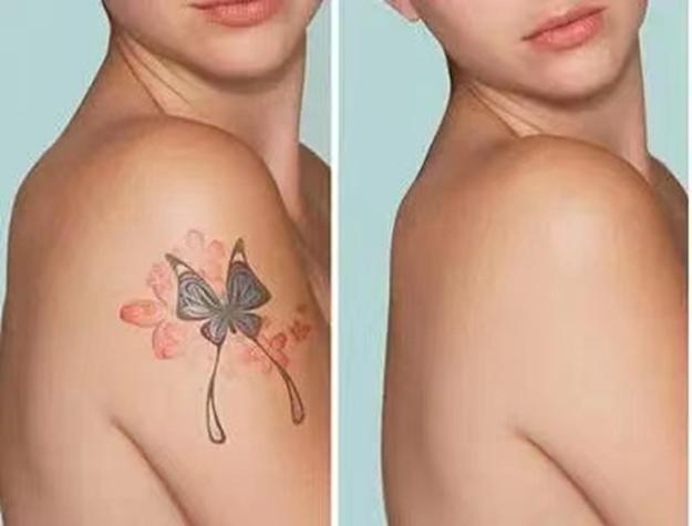 调q激光祛纹身的效果,有什么方法可以快速消除纹身