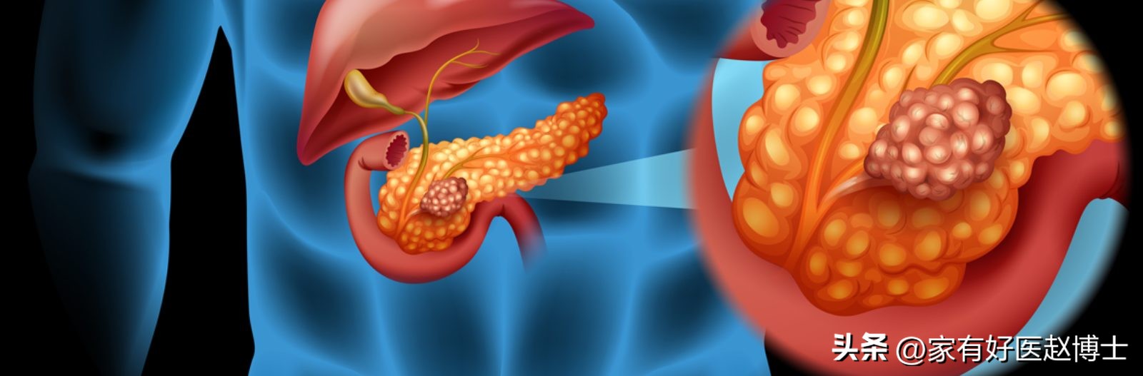 查出血糖高为什么控糖后更高,发现血糖升高一个月要吃药吗