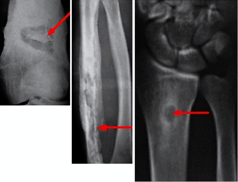 骨髓炎是什么病症,骨髓炎是什么病能治好吗