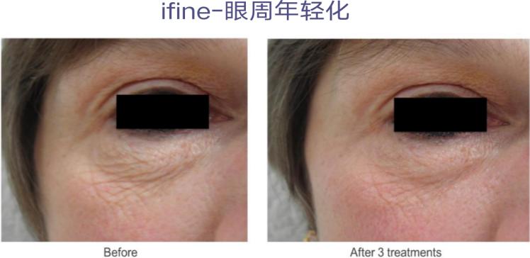 美迪迈相控微针是什么,美迪迈相控微针多久能化妆