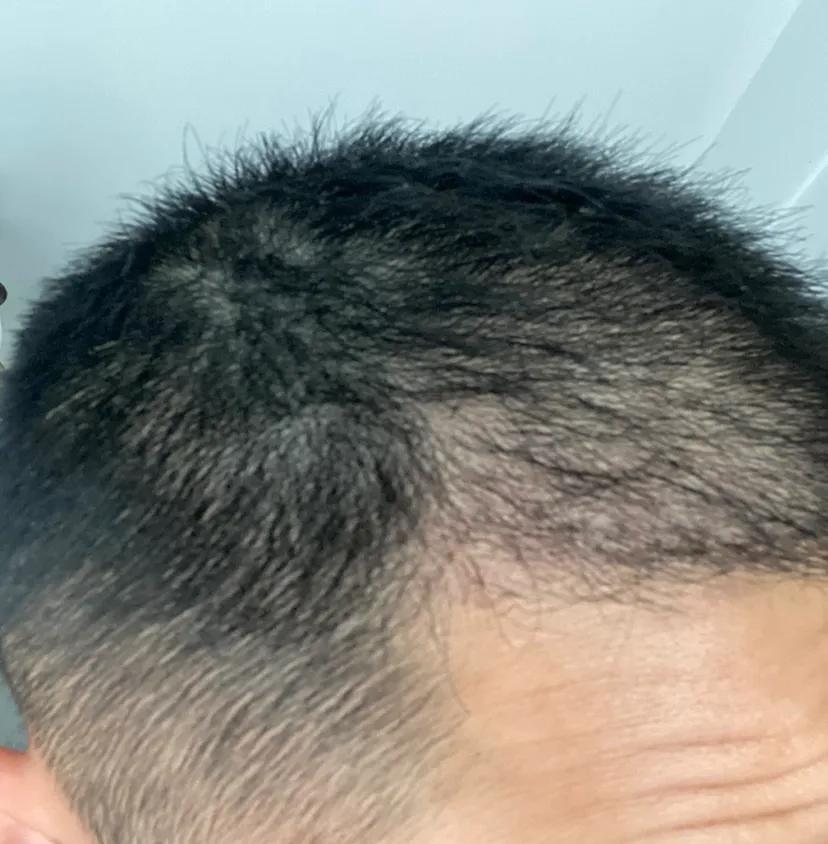 花费四万元植发一年后效果仍不明,男生大面积植发八个月真实效果