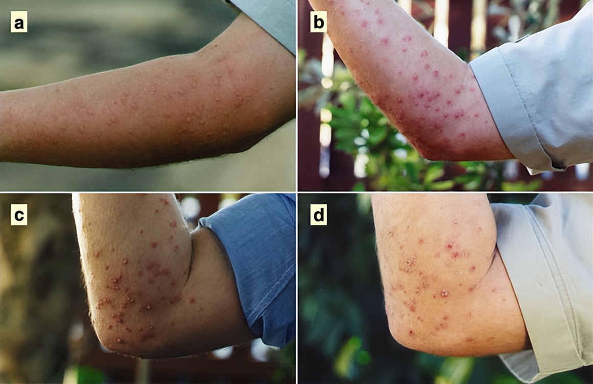 红火蚁咬伤人事件,小孩被红火蚁咬死亡