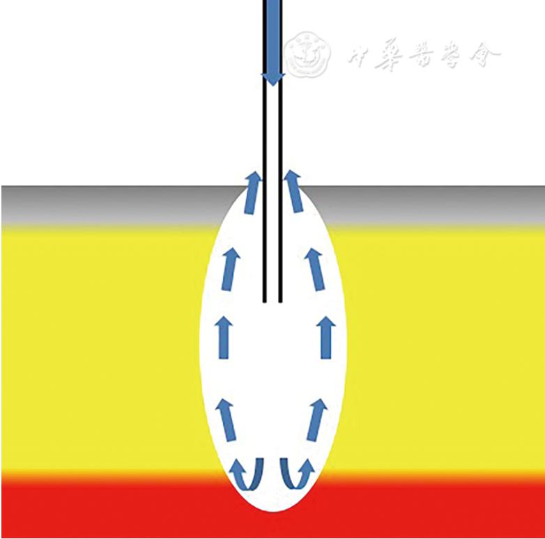 急诊清创缝合术操作流程,急诊清创缝合术后的护理措施