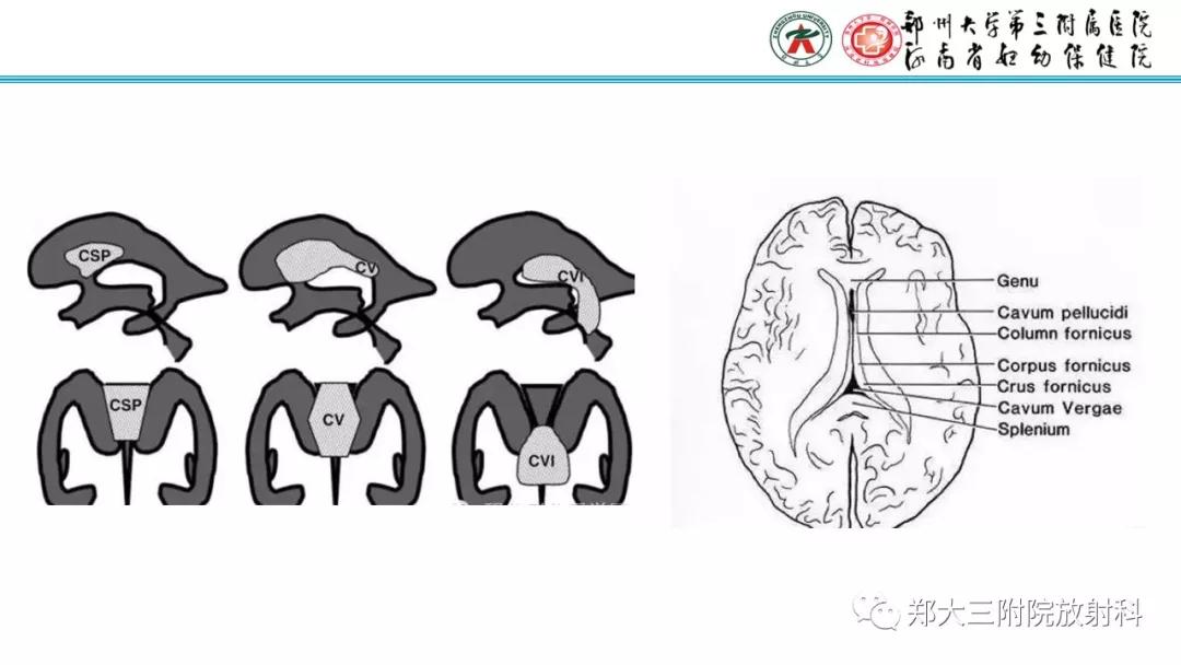 透明隔腔主要是判断什么,透明隔腔宽约10mm什么意思