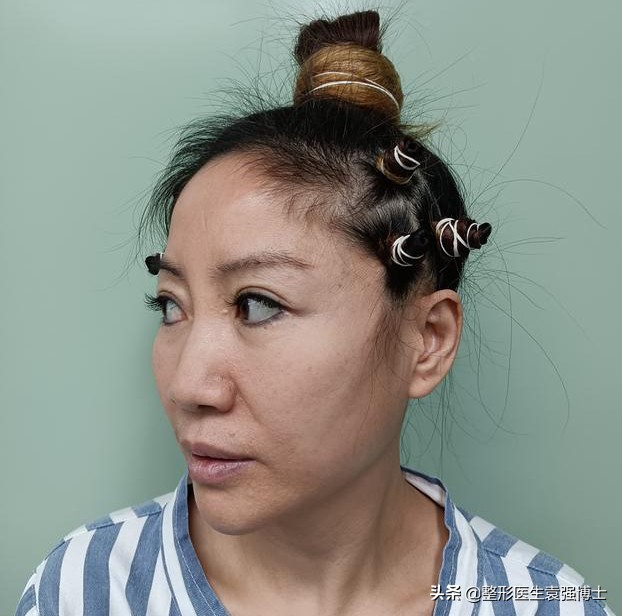 45岁做拉皮多少钱,北京做大拉皮前后对比照片图文