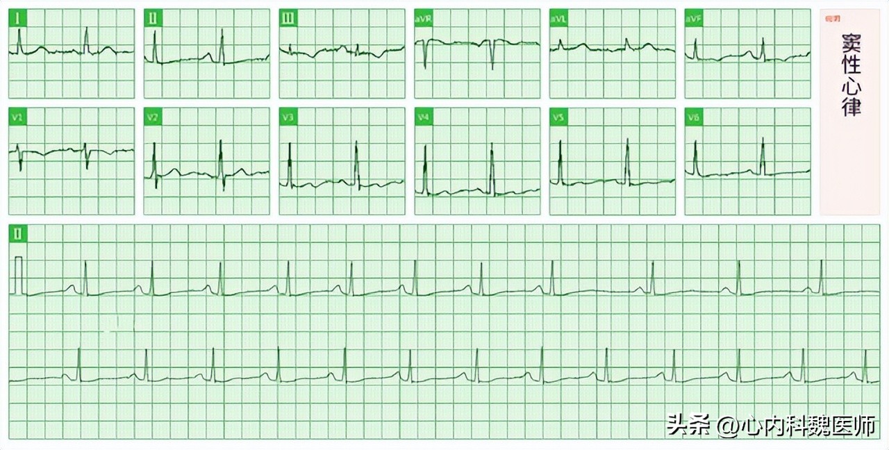 体检窦性心律正常心电图啥意思,体检报告显示窦性心律是什么意思