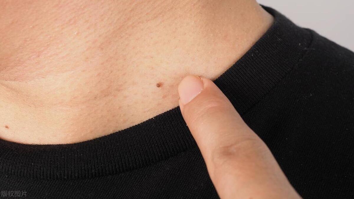 丝状疣怎么避免越来越多,丝状疣冷冻后注意事项