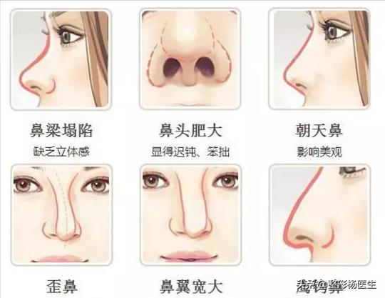 隆鼻最安全的是哪种隆鼻方法啊,先来了解一波隆鼻科普