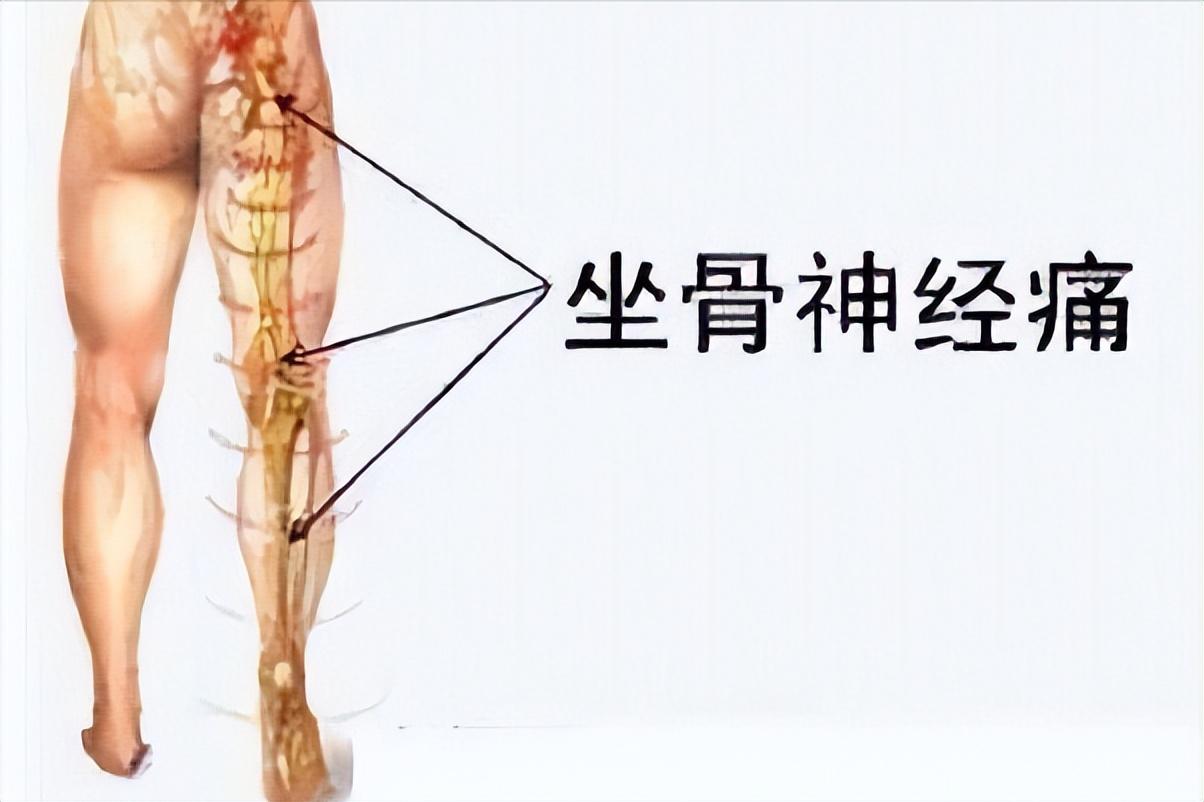 甲钴胺治疗腰椎间盘突出吃几片 (甲钴胺片治疗腰椎间盘突出吃多久)