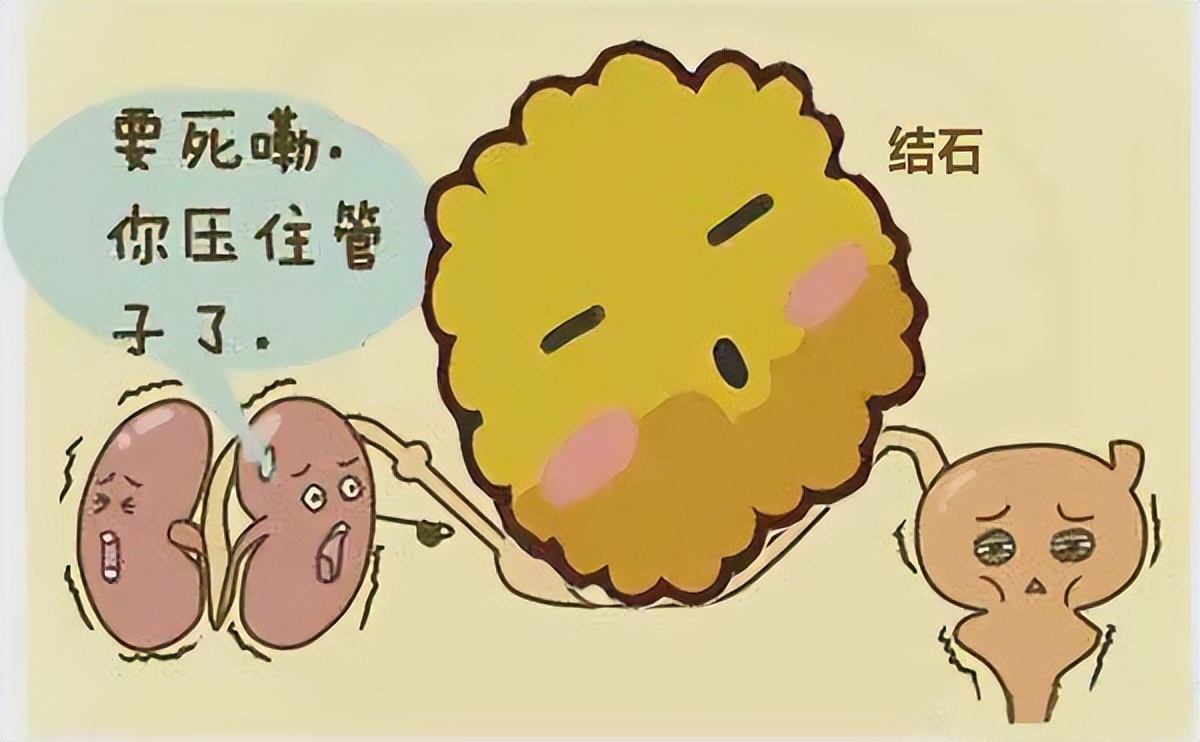 结石不用手术有特效药体外排石吗,有结石的不能吃哪些药物