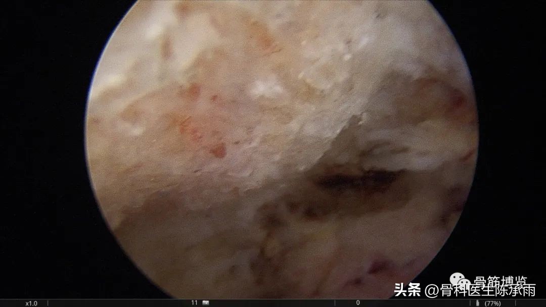 肱二头肌长头肌腱断裂超声报告,上臂肱二头肌