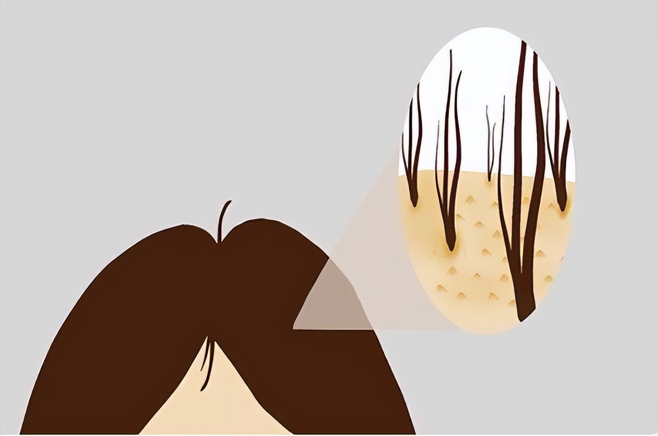 头皮上经常长脓包是怎么回事,头皮上经常长脓包和疙瘩是咋回事