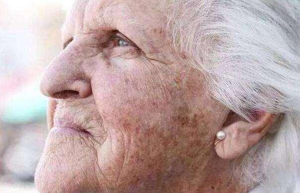 用红霉素软膏可以祛除老年斑吗,红霉素软膏消除老年斑