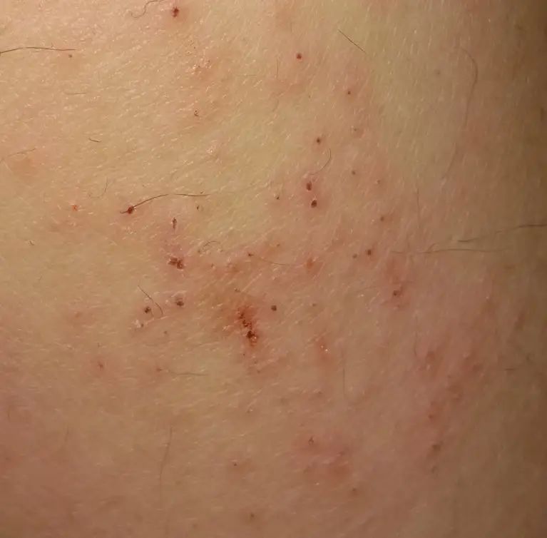 每到秋天，手和腿上就会出现各种干燥情况，还会脱皮，要怎么办？