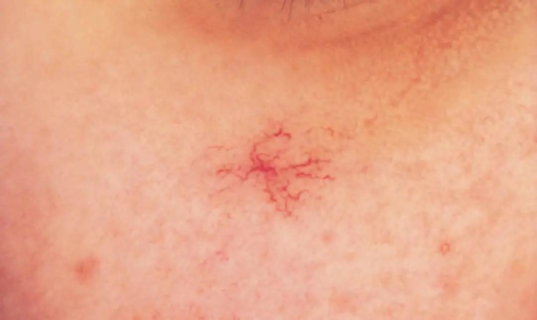 耳朵边有颗大痣这个位置会病变吗,什么样的痣容易癌变不能点