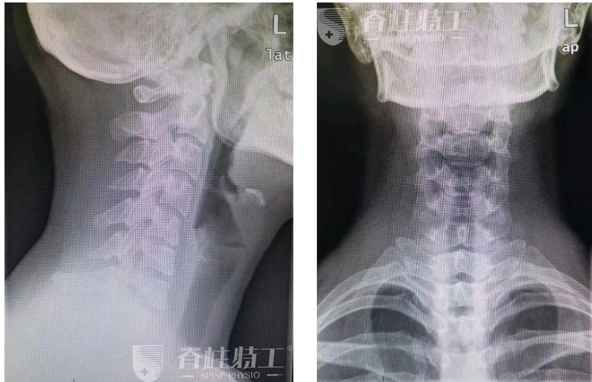 肩颈疼痛落枕一招搞定,落枕脖子疼高低肩最快的缓解方法