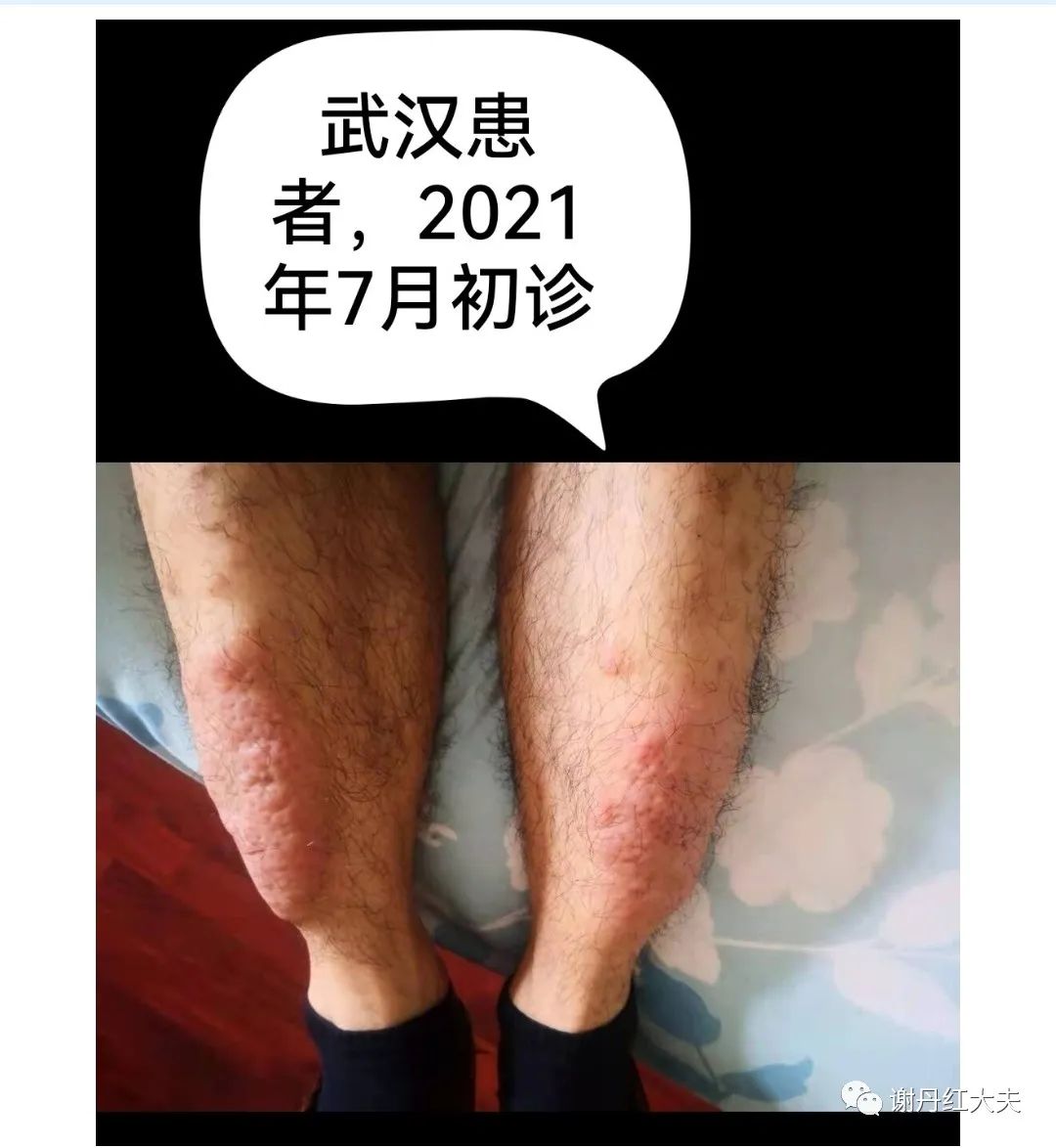 胫前黏液性水肿见于哪些病,胫前黏液性水肿为凹陷性水肿吗