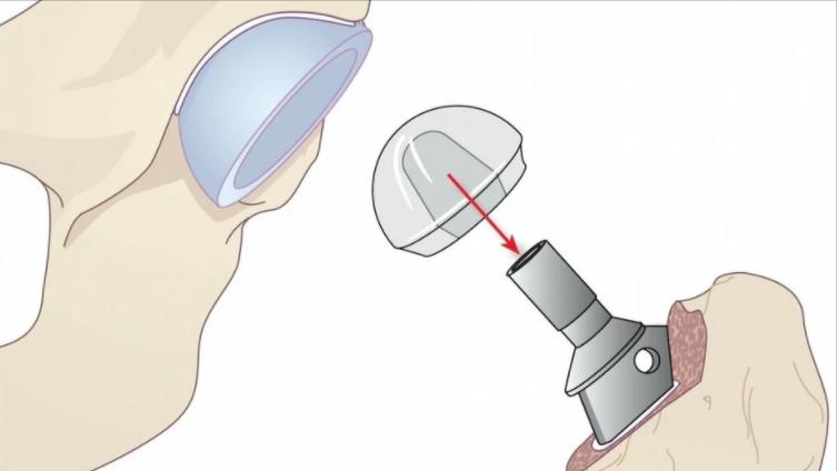 滑膜炎怎么恢复注意什么,滑膜炎怎样治疗才能快速恢复