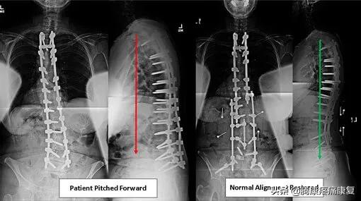 平背的成因,平背怎么造成的