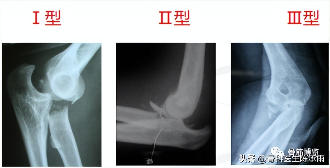 肘关节恐怖三联征最新治疗方法,肘关节恐怖三联征最佳治疗方法