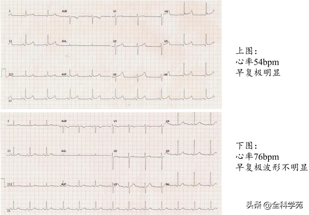 t波高尖心电图判断标准,t波高尖判断标准
