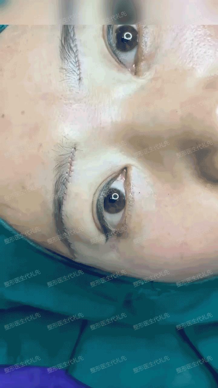 上眼窝凹陷下眼窝水肿怎么回事,眼窝凹陷眼周脂肪填充眼窝可以吗