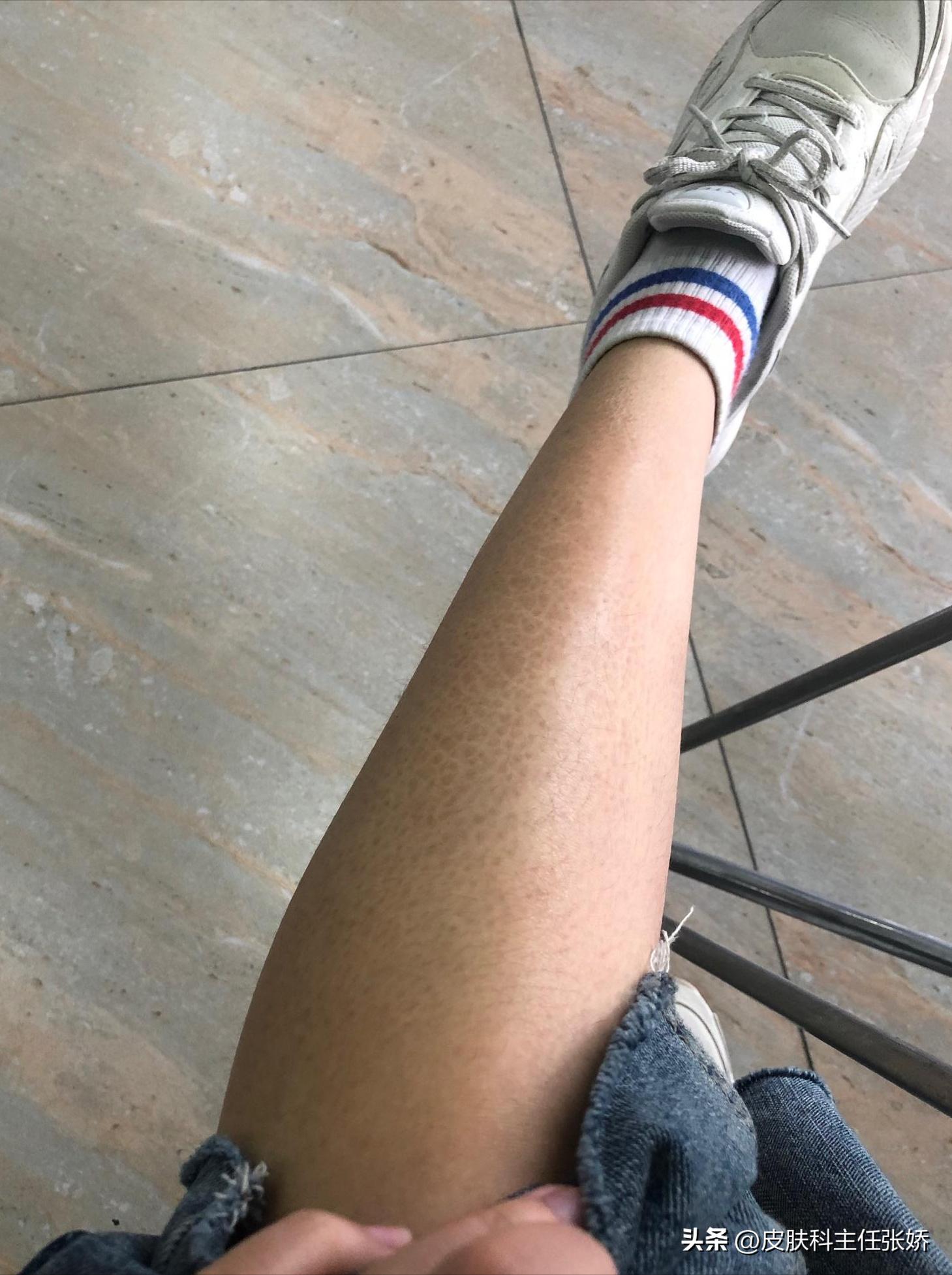 后天会得鱼鳞病吗,近亲会得鱼鳞病吗