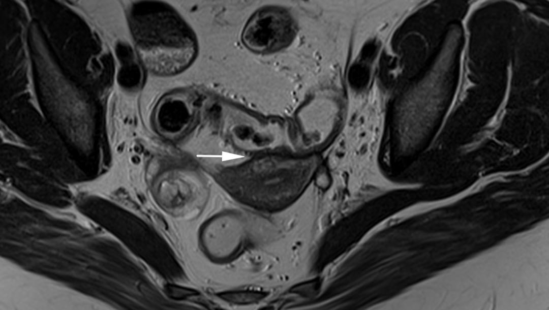 MRI如何评估子宫内膜异位症？这10个病例会帮助您