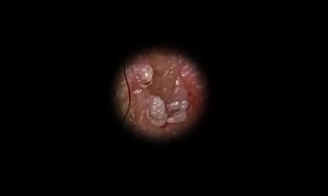 女性尖锐性湿疣早期什么症状,女性尖锐性湿疣早期症状什么样