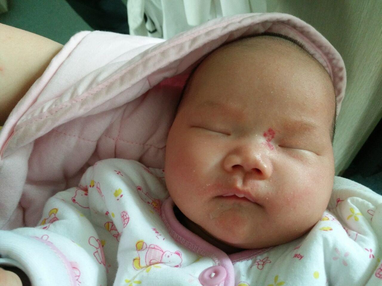 婴幼儿血管瘤会自行消退？小心长在这些部位的“瘤”，或危及生命