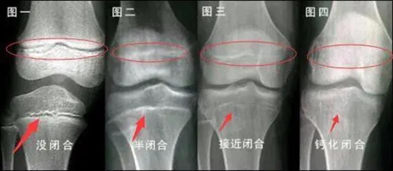影响孩子长高的五个关键因素,5个因素决定孩子能长高吗