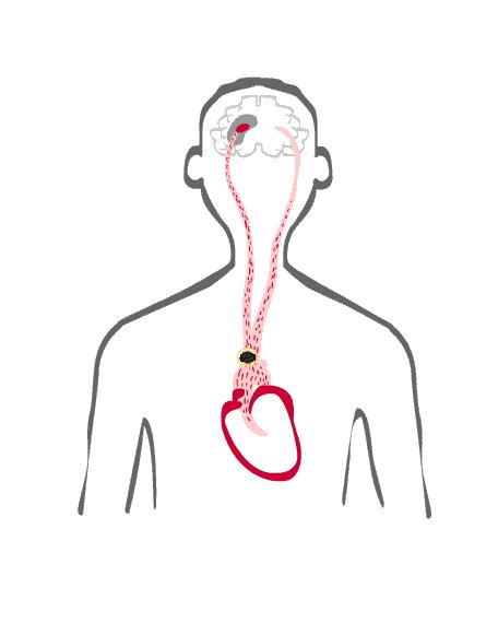 房颤最常见并发症是脑梗死吗,房颤引起的脑梗死怎么治