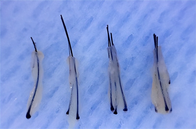 雄秃是哪里出了问题,雄秃真的无解吗