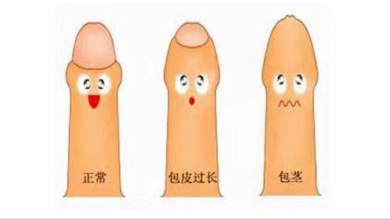 割了的包皮去哪了,28岁了包皮有必要割吗