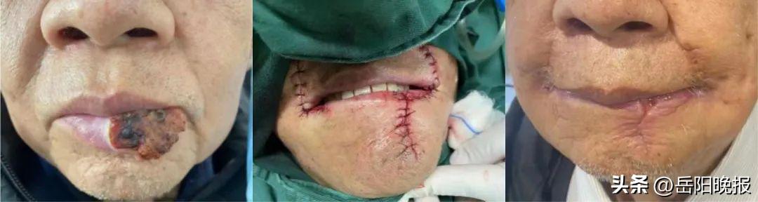 80岁老人切除息肉,83岁老爷子口腔肿瘤手术