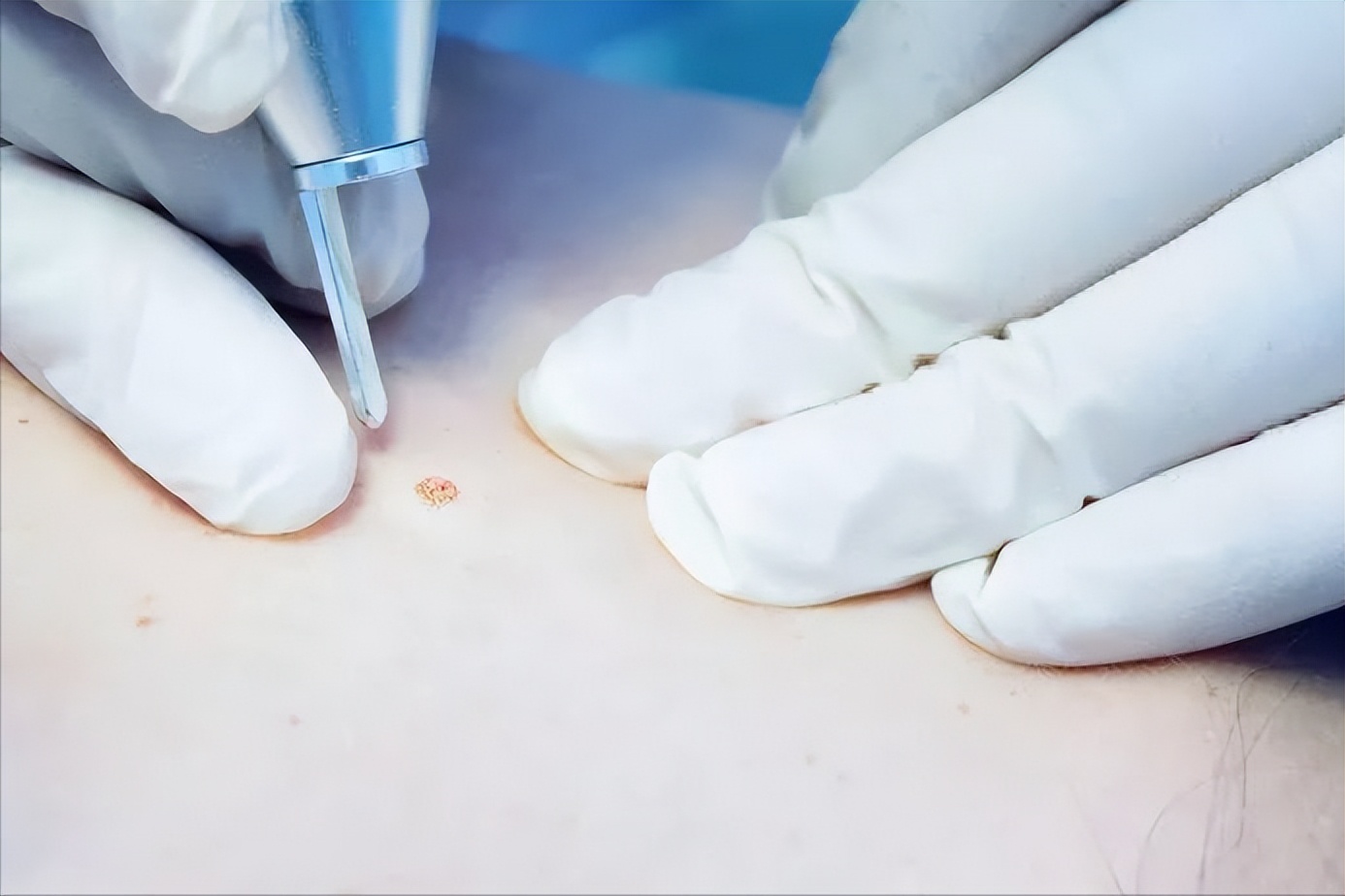 可以一个人取痣吗,点痣如何不翻车