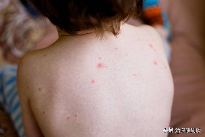 *麻疹荨**是怎么产生的？医生：多半与4个因素有关，别傻傻往上撞