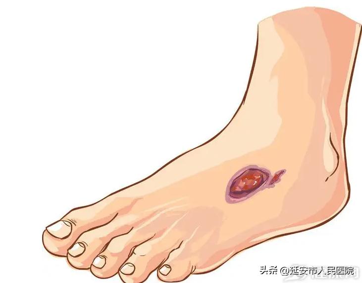 三氧大自血疗法——延安市人民医院疼痛康复科特色诊疗项目