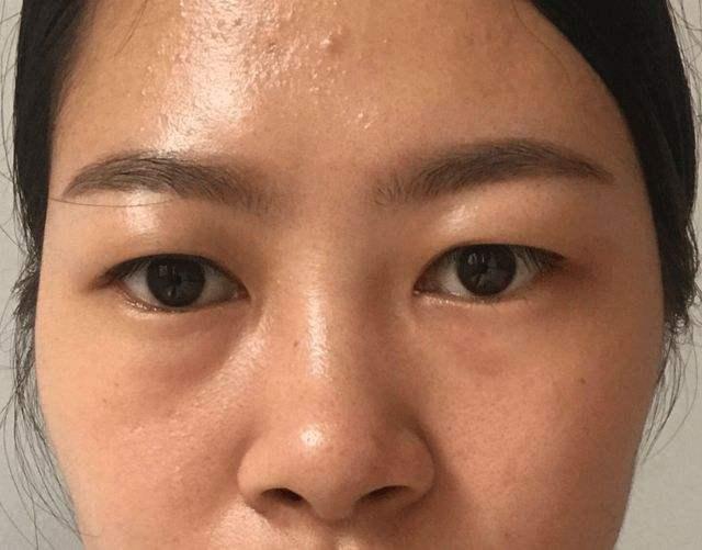 21岁女生到医院检查hpv病,29岁女子检查hpv16感染